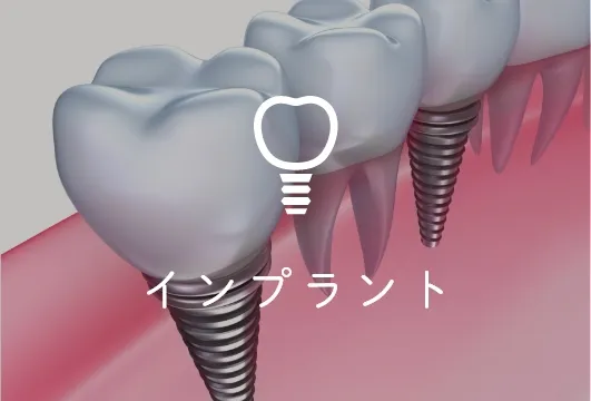 インプラント