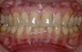 審美治療(ホワイトニング) 治療例