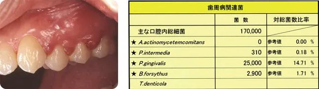 抗菌療法 初診時