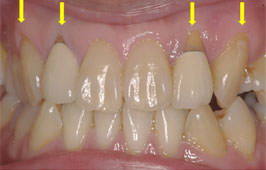 歯周形成外科 治療例01 Before