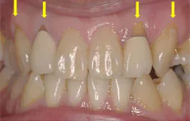 歯周形成外科 治療例01 Before