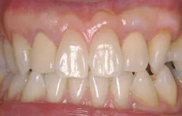 歯周形成外科 治療例01 After